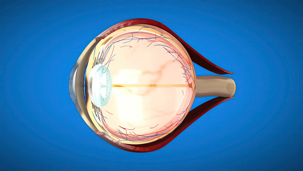 Optic Neuritis