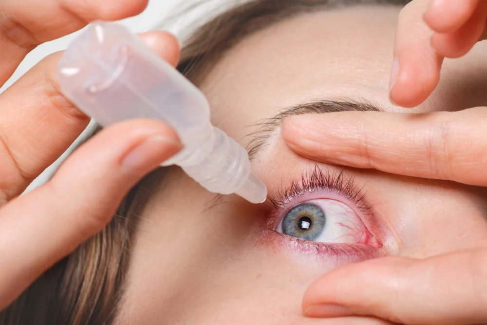 Ocular Rosacea
